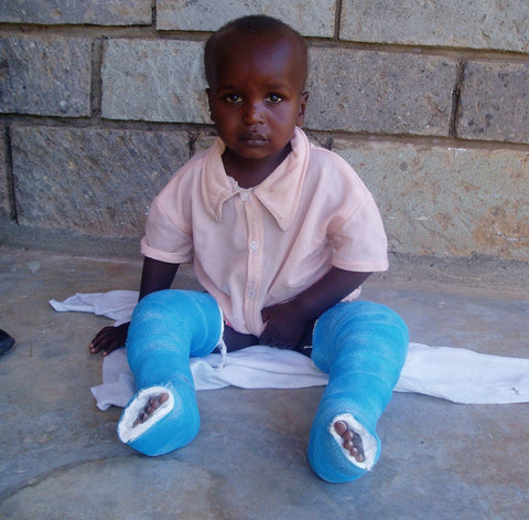 Give a gift that matters: a donation in your friend's name. This gift will provide casts for 5 children born with clubfoot. For these children, casts mean a cu
